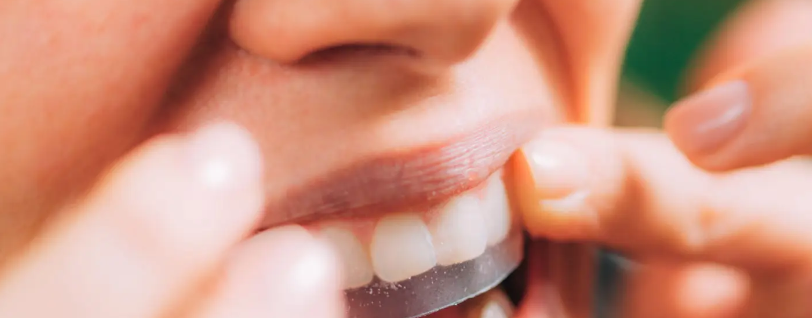 치아 미백 후회